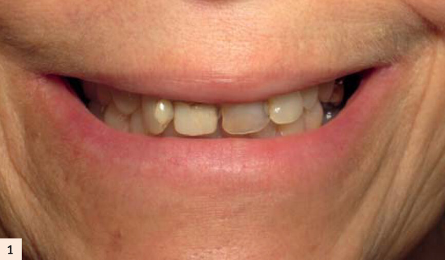 Sourire non gingival de la patiente.