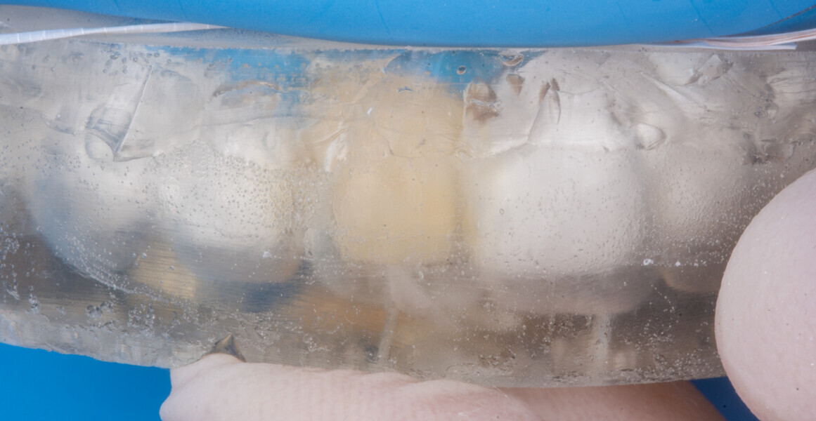 Fig. 18 : Essayage et Vérification de l’adaptation de la clef transparente réalisée avec Exaclear.