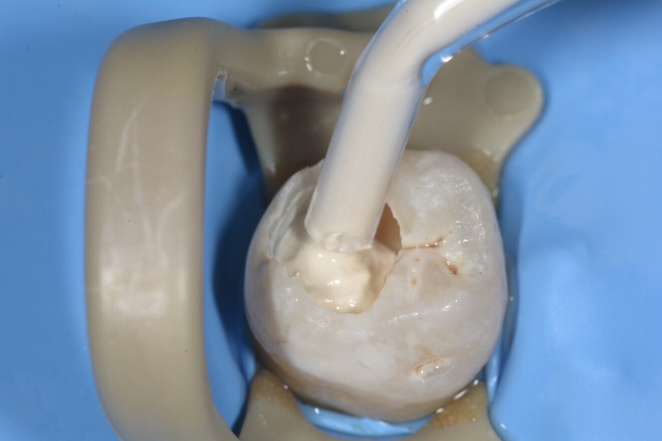 Fig. 12 : Mise en place de la Biodentine XP.