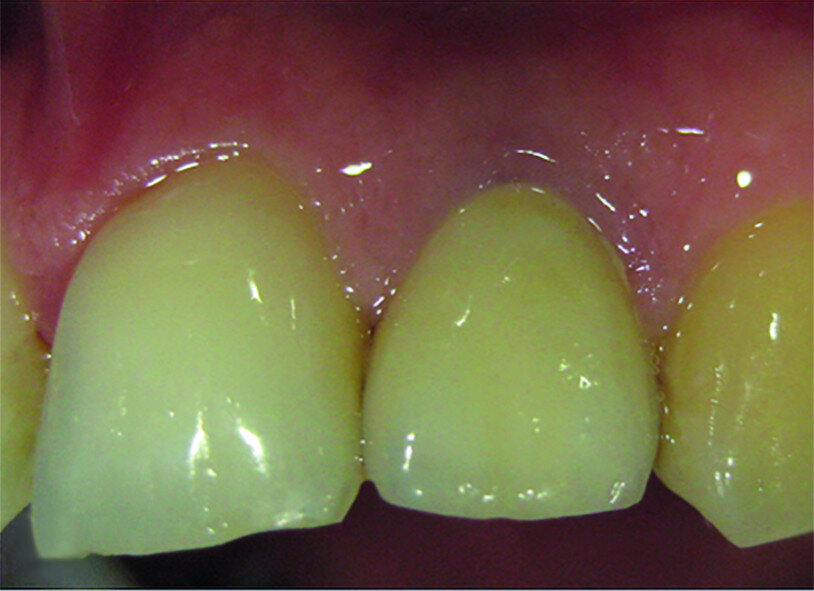 Fig. 18b: Zirconia crown on a printed model (a). Crown set in the mouth (b).