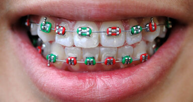 En Asie : porter des bagues d´appareils dentaires est très tendance