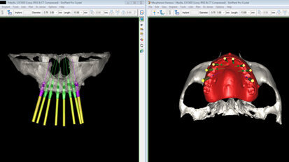 Restauro immediato nel mascellare totalmente edentulo