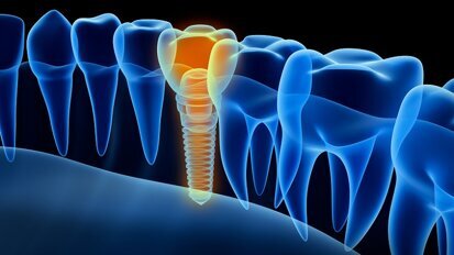 EAO Junior Committee presents guidelines for development of implant dentistry in the next decade