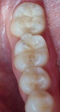 Fig. 8: Final result: easily obtained without the need for shaping or polishing.