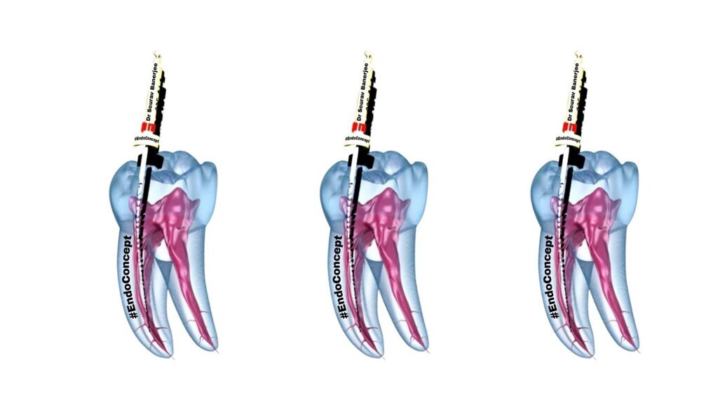 CHF technique prevents common endodontic mishaps