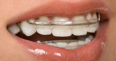 Kritiek op orthodontiekorting door NZa