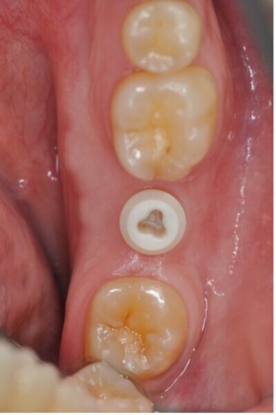 Fig. 12 : Système d’implant full zircone très stable sur le plan électrochimique. Une alternative sérieuse aux systèmes implantaires en titane. Pas de péri-implantite survenue sur une longue période d’observation de douze ans.73