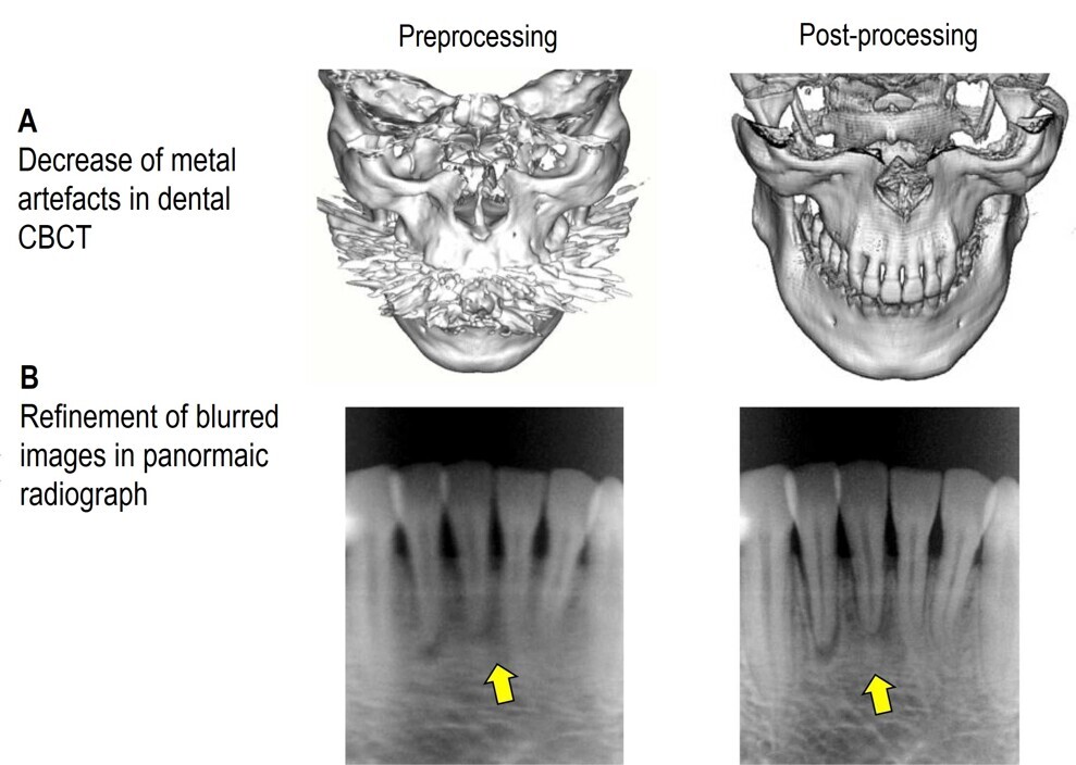Post-processing employing artificial intelligence (AI) in dental CBCT images (A) and panoramic radiographs (B) significantly reduces metal artefacts and enhances image clarity. These improvements in image quality support more accurate diagnosis, exemplifying the transformative impact of AI in dental imaging.6