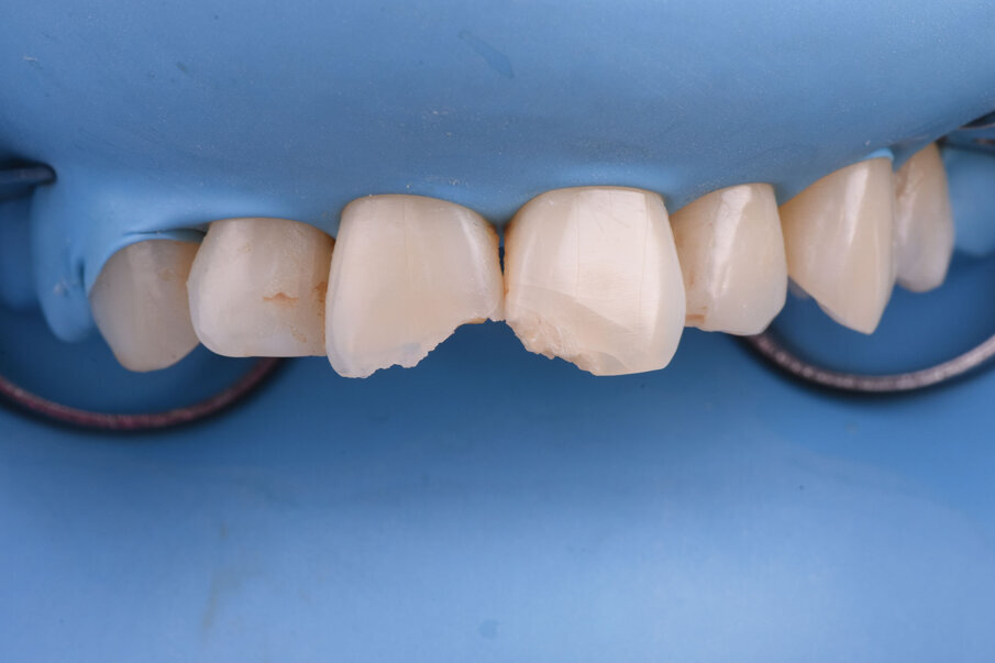 Sl. 6a: Preparacija zuba, zakošavanje preparacije  sa vestibularne strane (6b). 