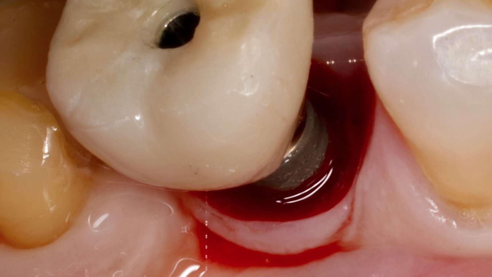 Interacción entre factores protésicos y sistémicos en la periimplantitis 