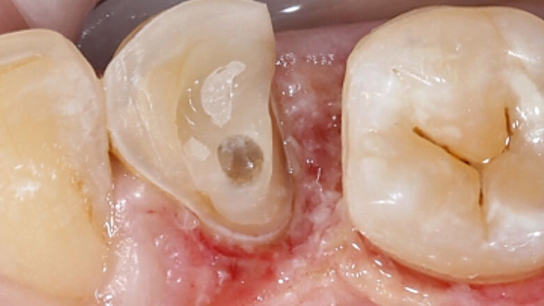 Fig. 3. Durante la preparación se procuró no dejar ningún borde afilado en la cavidad.