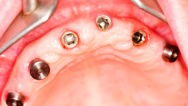 Anche nei pazienti diabetici gli impianti possono avere un buon successo