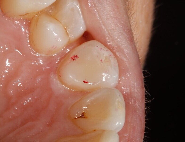 Fig.12: 2017—palatal platforms placed on the maxillary canines using Venus Diamond (Kulzer).