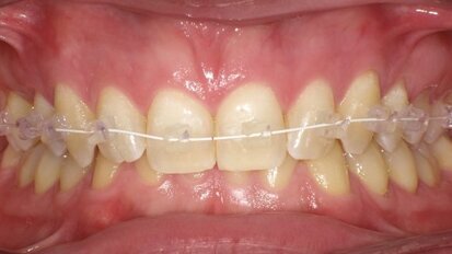 Nuovi traguardi ortodontici al servizio dell’estetica