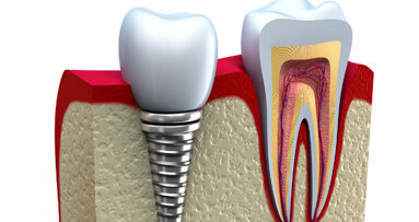 De l´intérêt des modifications de surface sur les implants en titane