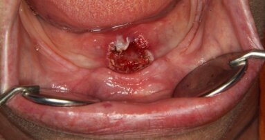 Laser diodowy – nowoczesne narzędzie w chirurgii tkanek miękkich jamy ustnej