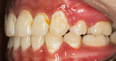 Dosáhneme hluboké remineralizace