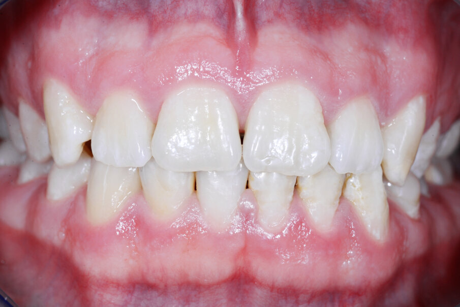 Figs. 15: Restoration in amelogenesis with novel BRILLIANT COMPONEER