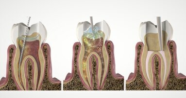 Discover SWEEPS for a more effective endodontic treatment at IDS