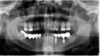 Prosthetic rehabilitation with short GTB implants: A case report with nine-year follow-up