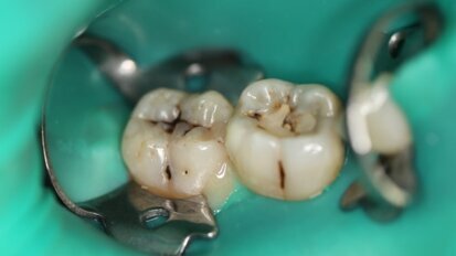 Leczenie próchnicy laserem Er:YAG zgodnie z koncepcją terapii minimalnie inwazyjnej