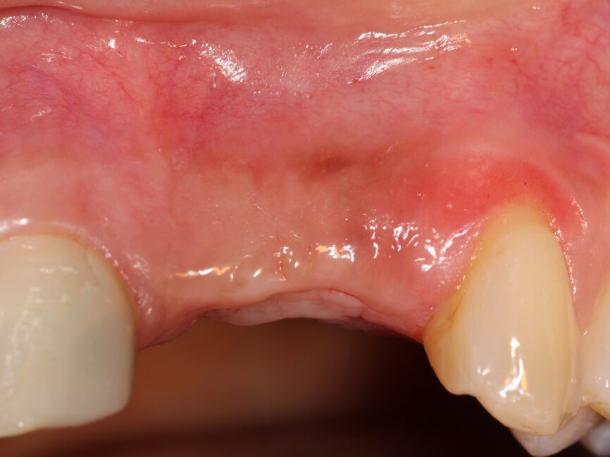 Fig. 1: Deficient facial aspect to the anterior maxilla resulting from resorption following tooth extraction. (Photos provided by Dr. Arun K. Garg; Dr. Gregori M. Kurtzman; Dr. Renato Rossi Jr.; and Dr. Maria del Pilar Rios)