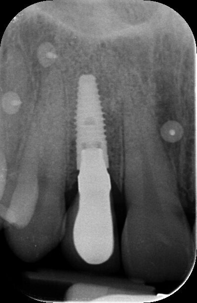 Fig. 17 - Rx endorale di controllo della riabilitazione finale.