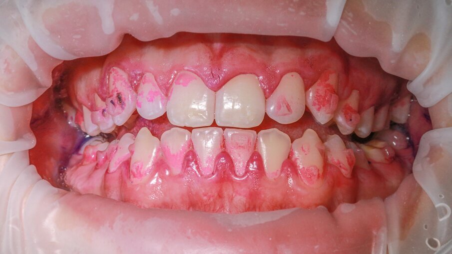 Fig. 7 - Localizzazione del biofilm (© Marie-Claude Ekstand).