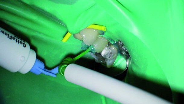 Acute endodontische problemen