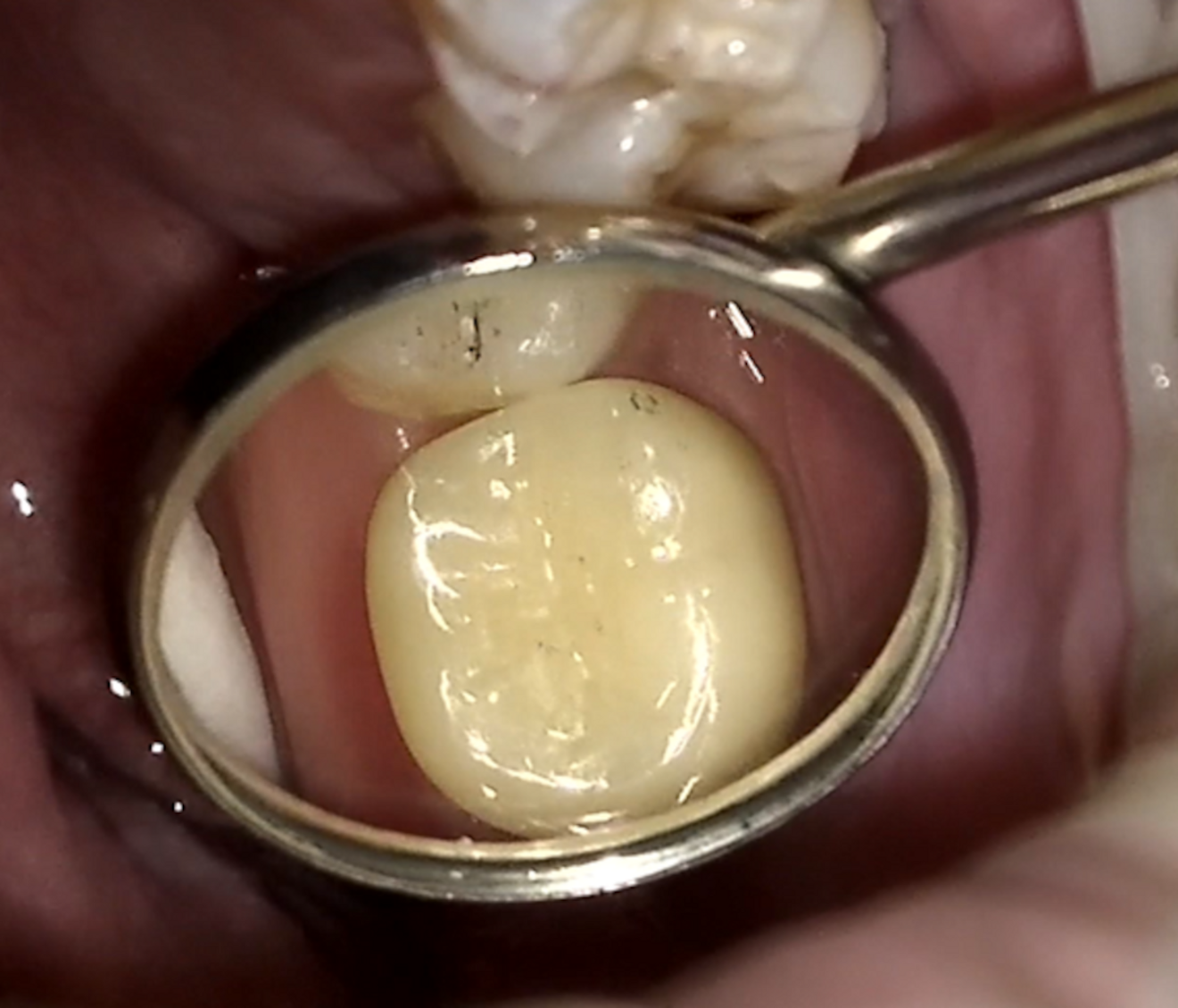 Fig. 14: Occlusal mirror view demonstrating integration and contact distribution.