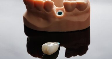 3D-printed hybrid composite restoration in a fully digital workflow