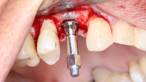 Comparative Study — of implant placement torque and resonance frequency analysis on the implant and abutment
