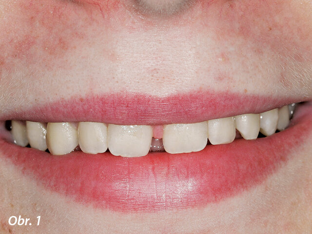 Iniciální situace ukazující diastema.