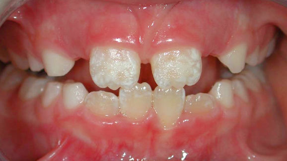 Липсата на естествено хранене може да предразположи децата към емайлови дисплазии