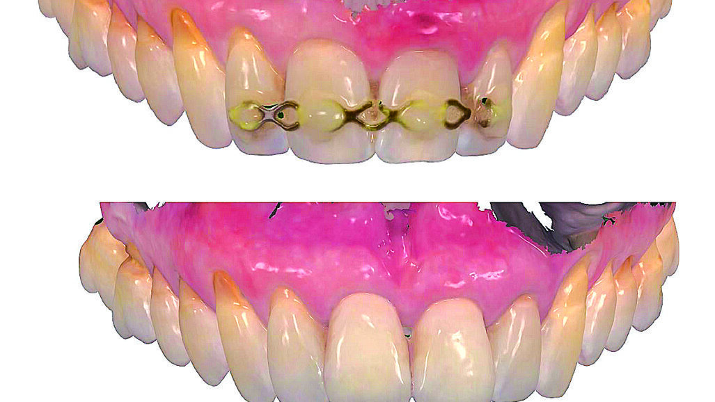 Estetska restauracija nakon traume prednjih zubi