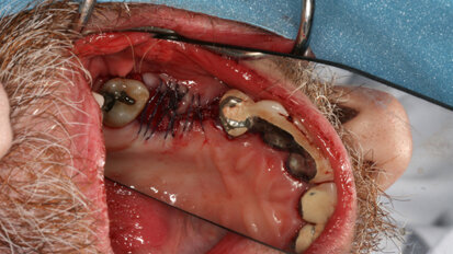 Patient’s own stem cells are harvested and transplanted into jaw