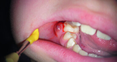 Apical lesions: To treat or not to treat?