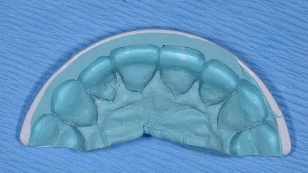 Improving success with your cosmetic cases using the TMJ QuickSplint