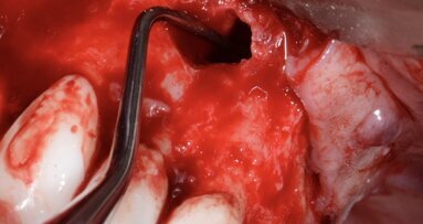 Nulta apikotomija u endodontskoj mikrohirurgiji