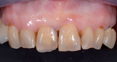 Posizionamento di impianto post-estrattivo a protesizzazione immediata in area estetica mascellare