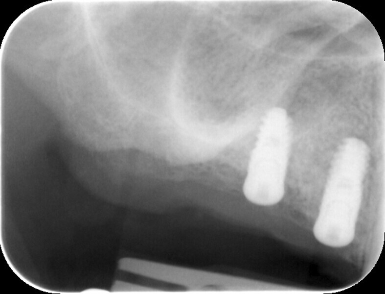 Fig. 11: Post-op radiograph of the implants.