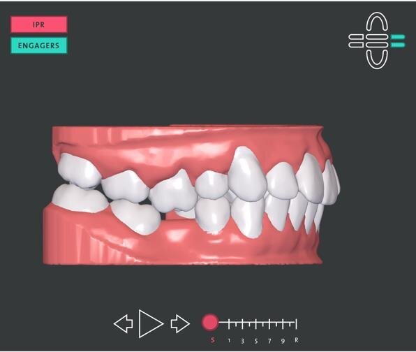 Figg. 4a, 4b - Pianificazione dei momenti. Si noti l’intrusione dell’elemento 1.6.