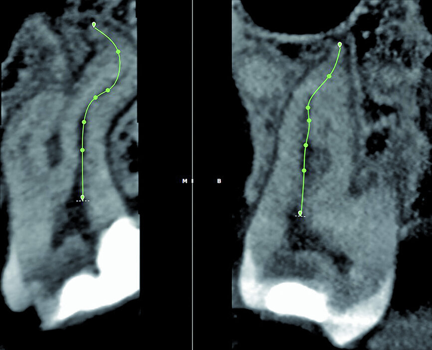 Fig. 9: Corrections made for the mesiobuccal root canal according to the canal configuration that can be viewed in different planes in the software.