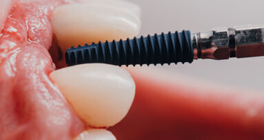 Over 10,000 dental implants placed using Yomi robotic system