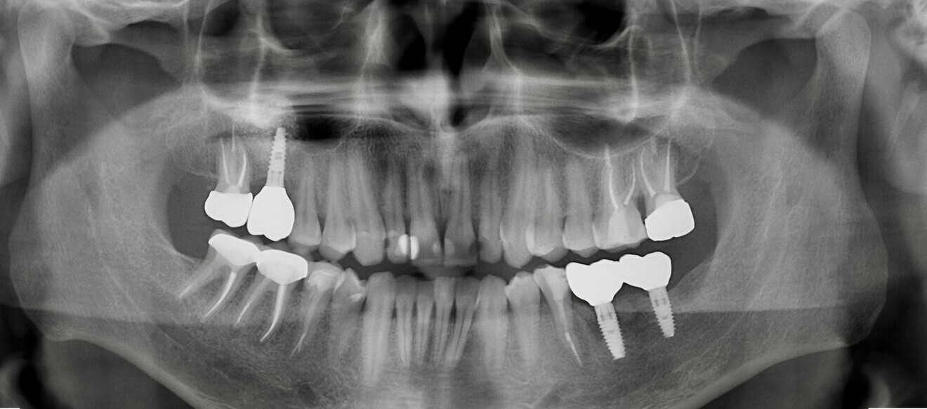 Fig. 21 : Radiographie prise  en 2019.