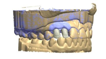 Odwzorowanie profilu wyłaniania implantu przy pomocy skanera wewnątrzustnego