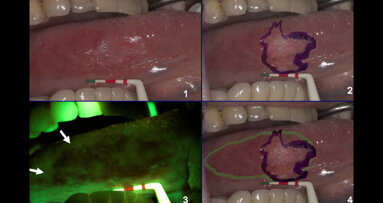 Goccles: 60 secondi possono salvare una vita