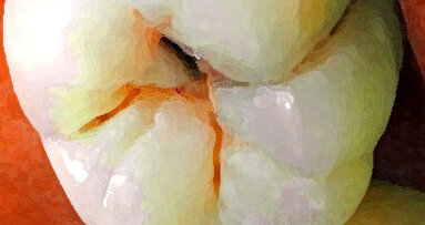 Znanstvenici otkrili molekulu protiv karijesa