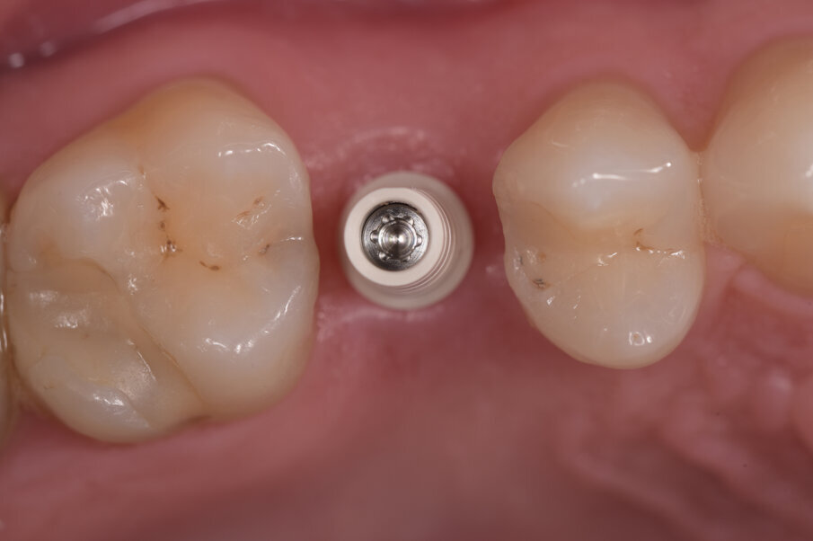Fig. 4 - Posizionamento di un moncone provvisorio in PEEK a cui verrà incollata la corona provvisorio realizzata con tecnica CAD-CAM, permettendo l’avvitamento della medesima.