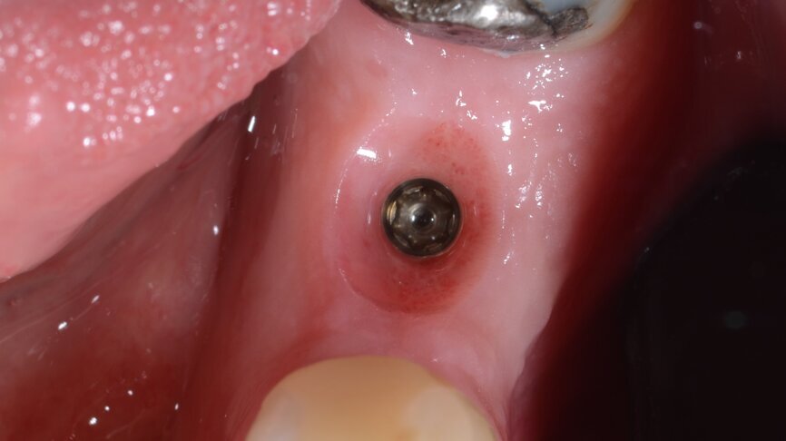 Fig. 15: Extraordinary keratinisation pattern visible when the temporary crown was removed.